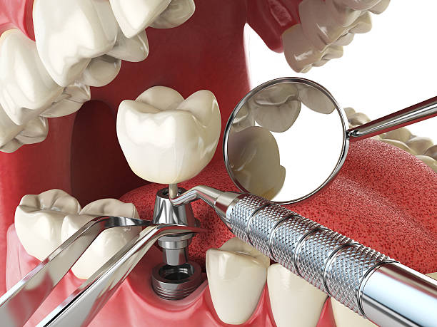 Best Urgent Care for Lost Fillings or Crowns in South Charleston, WV
